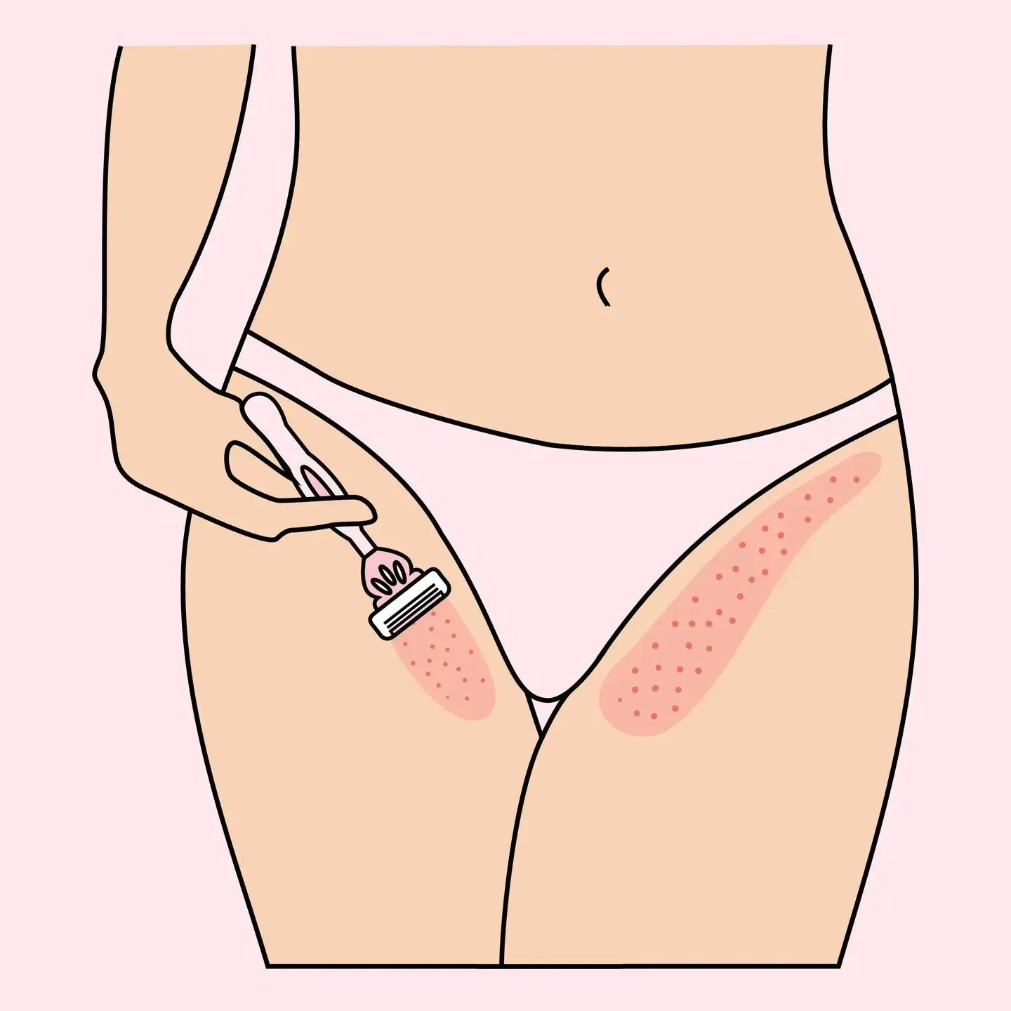 Rasierbrand im Intimbereich behandeln – so geht’s shinie