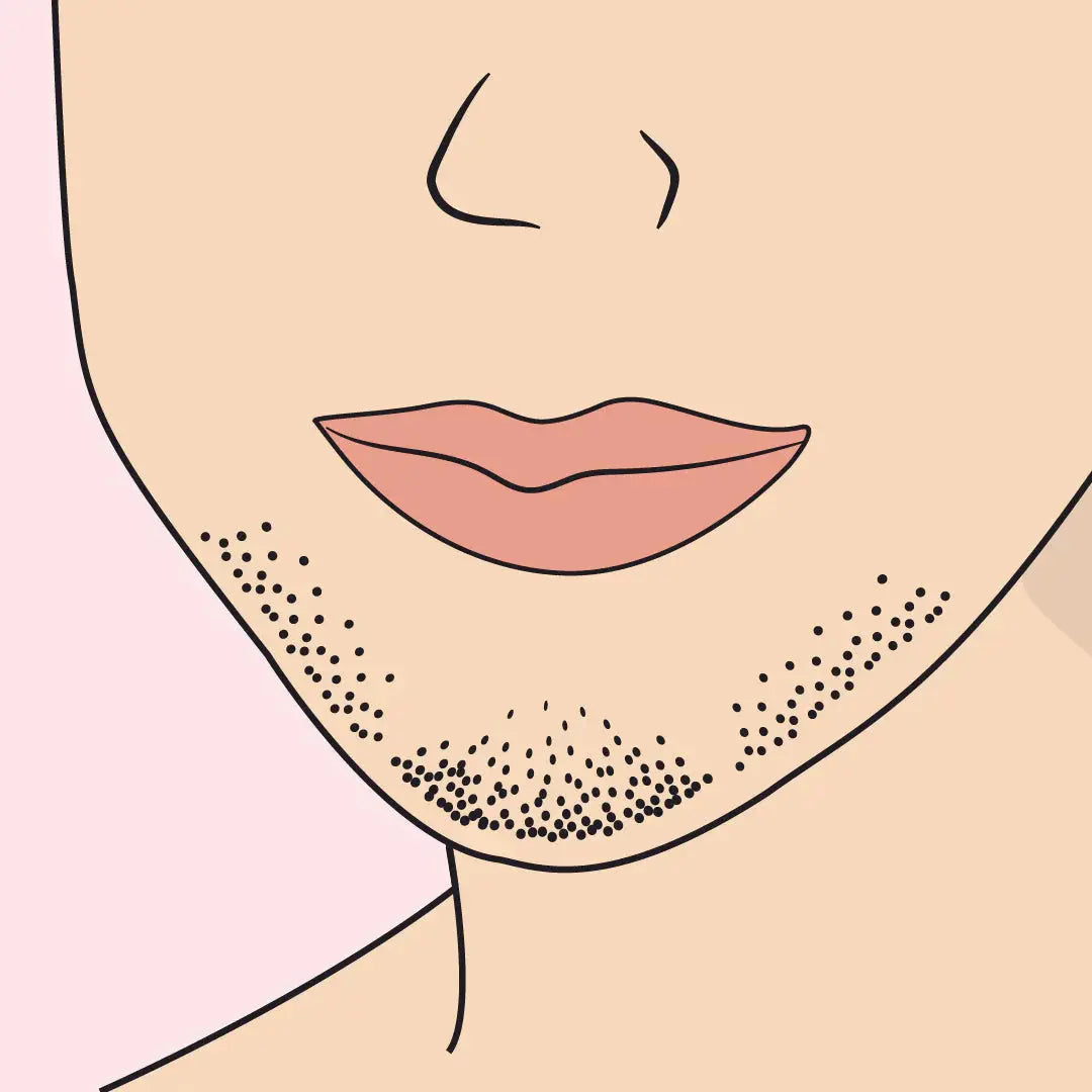 PCOS & Haarwuchs: Was hilft wirklich? shinie